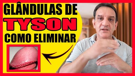 que son glandulas de tyson|Pápulas perladas: qué son, son contagiosas y cómo quitar